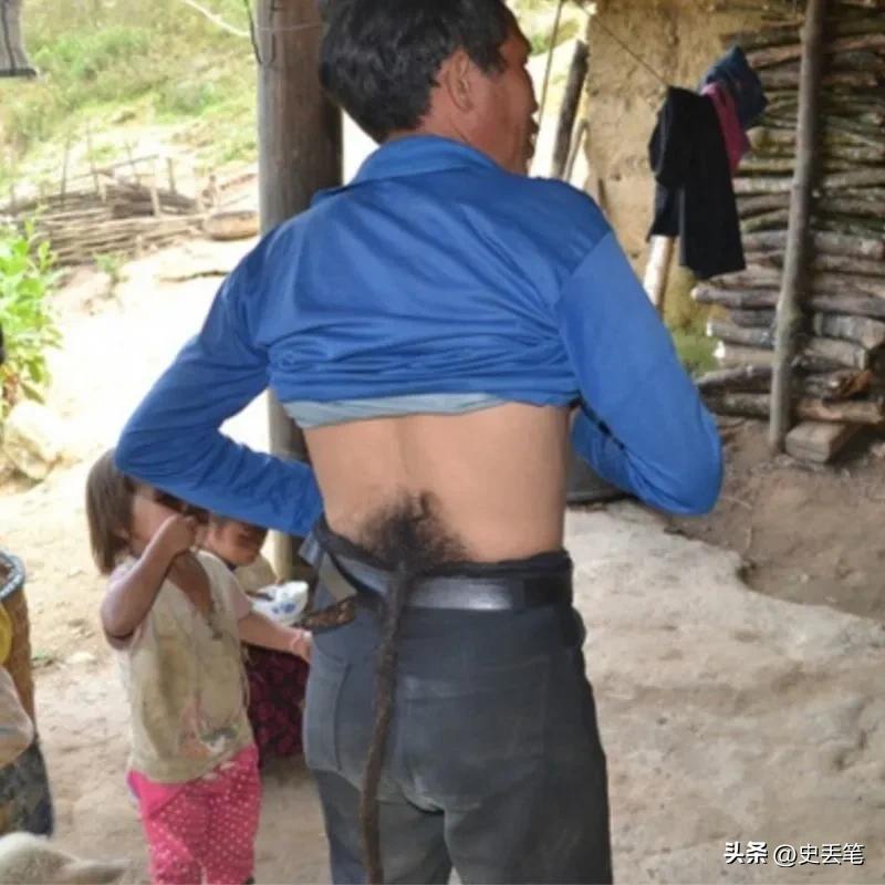 越南有位男人身后长有黑色“尾巴”，每次只要一剪掉就会生病