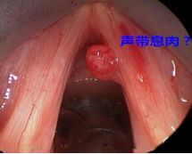 嗓音障碍的定义、形成、表现和应对方法丨科普