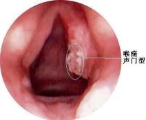 嗓音障碍的定义、形成、表现和应对方法丨科普