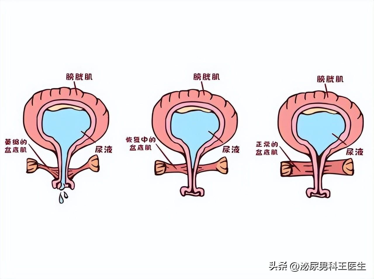 女子阴挺是什么情况 女性阴挺的原因和症状丨科普